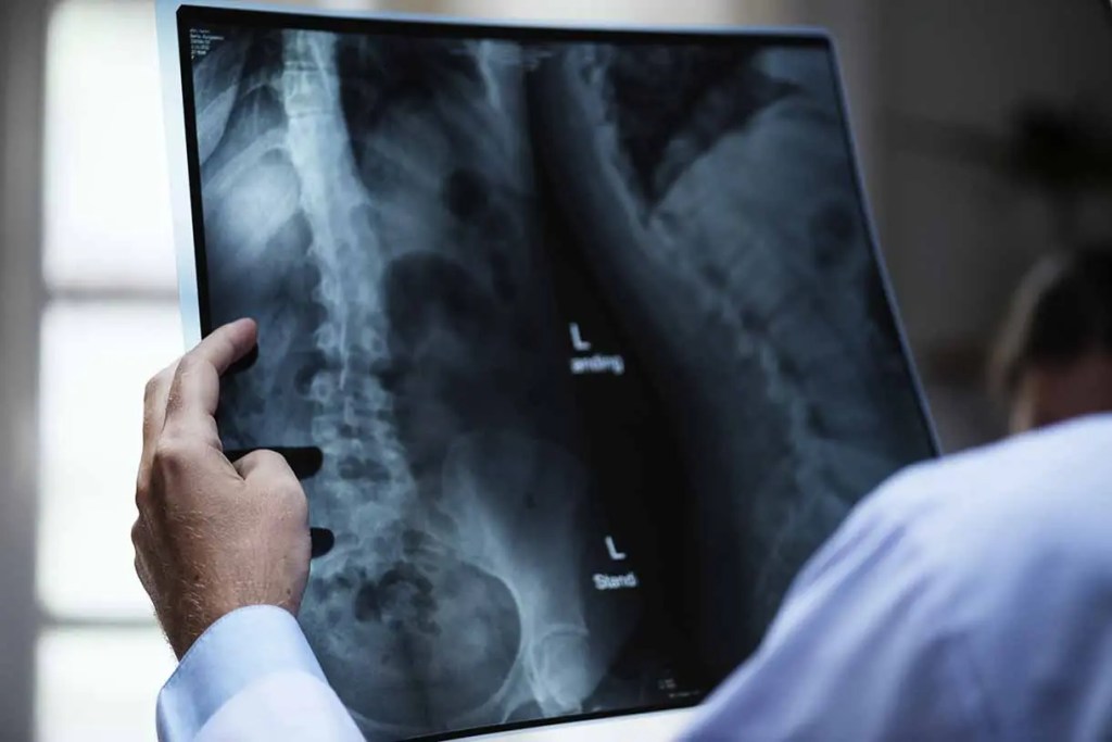 Radiografía de la columna vertebral sostenida por una persona, mostrando detalles óseos y marcas de orientación.